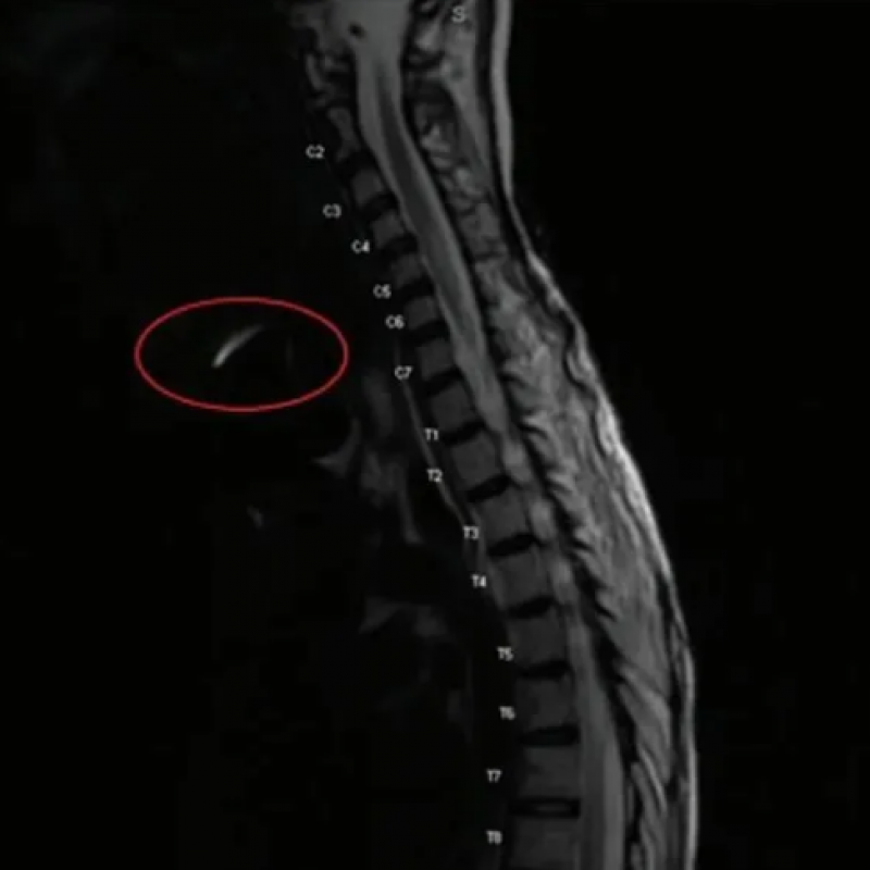 麻醉病例︱气管切开导管指示球囊弹簧：一个未被识别的磁共振成像金属伪影来源