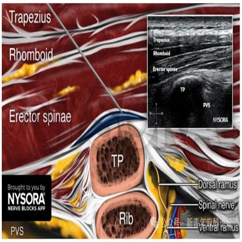 警惕！常规镇痛操作后无法排尿？这例腰椎 ESPB 并发症值得所有麻醉科医生学习
