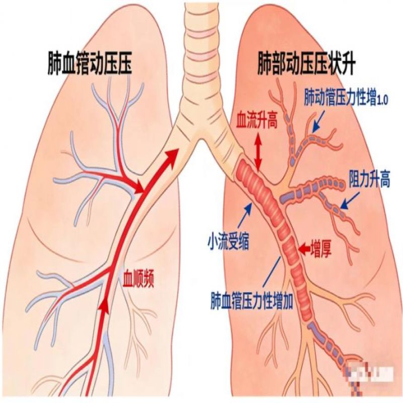 基础知识 | 围术期肺保护性通气策略