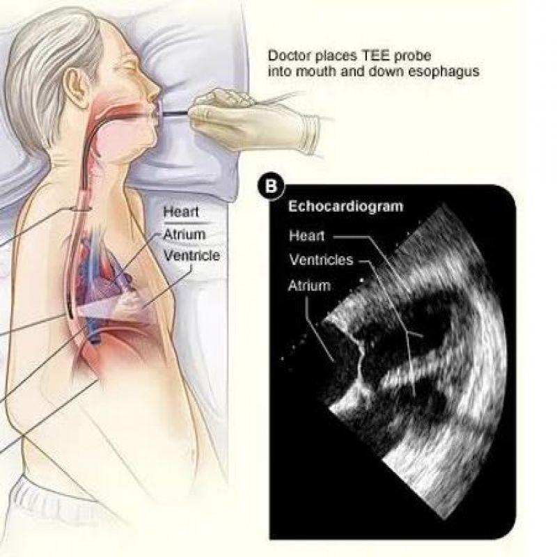 TEE丨这篇「经食管超声标准切面」是我见过的最精彩的，没有之一！