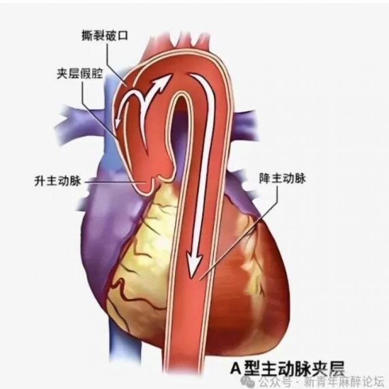 一文掌握｜A 型主动脉夹层围手术期麻醉管理全要点